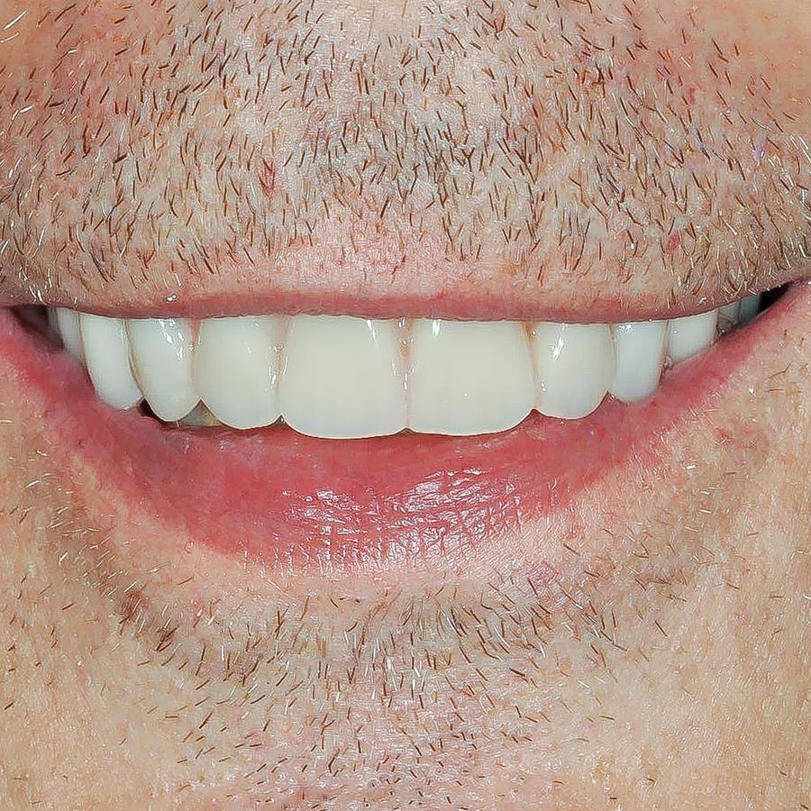 smile in a day 4 after
